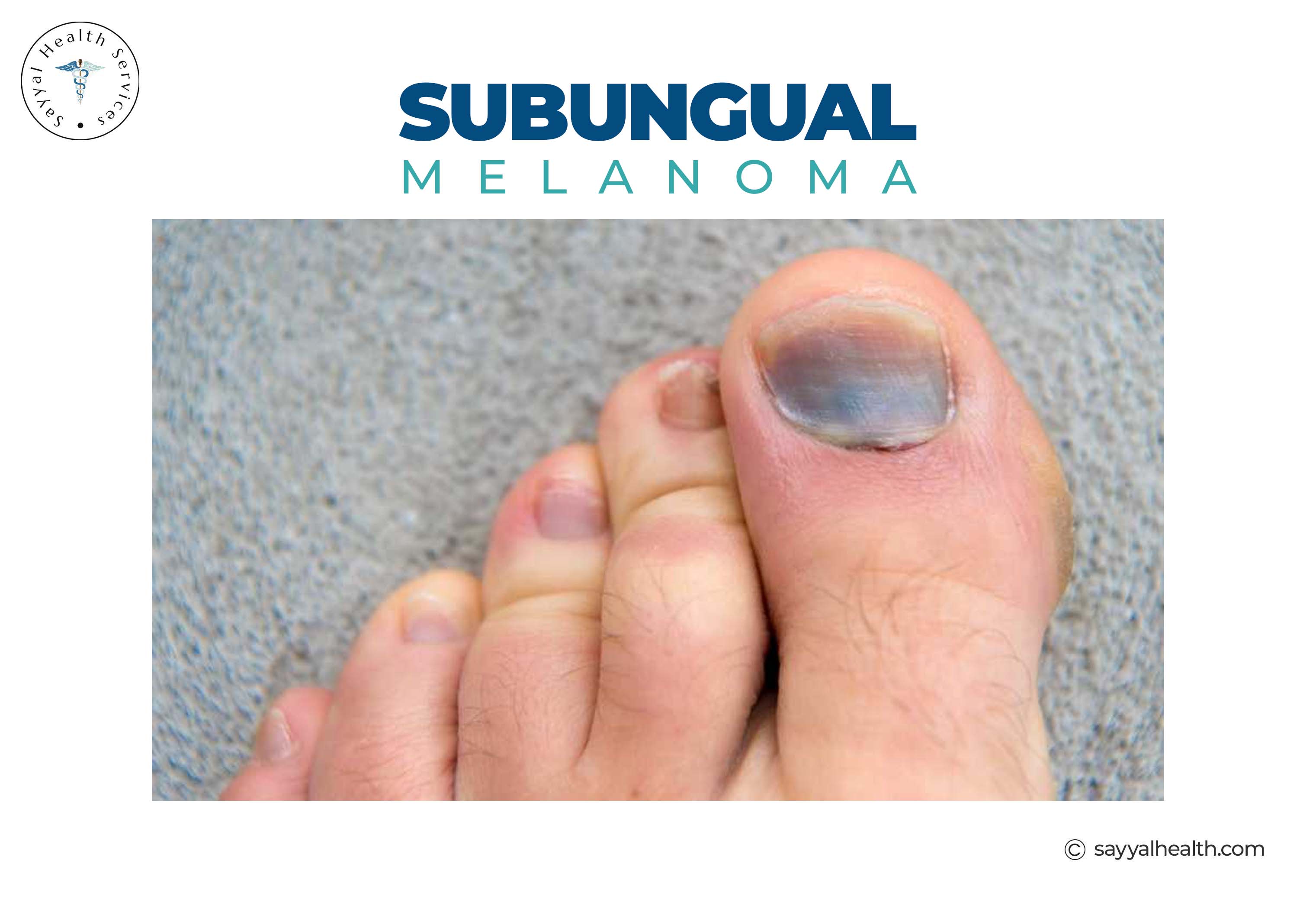 Subungual melanoma showing dark discoloration under toenail